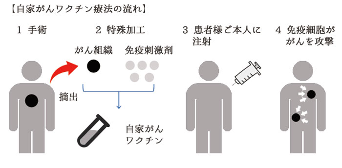 自家がんワクチン療法の流れ
１．手術
２．特殊加工
３．患者ご本人に注射
４．免疫細胞ががんを攻撃